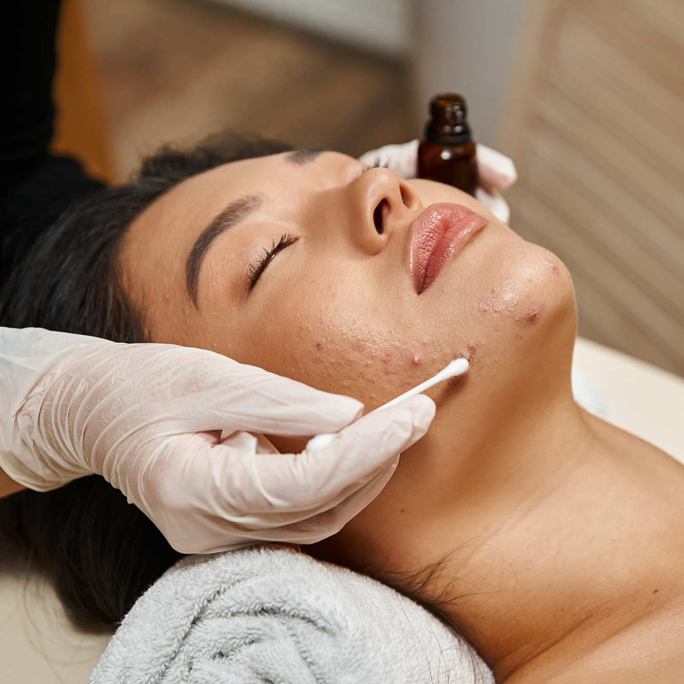 Tratamientos faciales Tratamiento antiacné Ana Hata Belleza