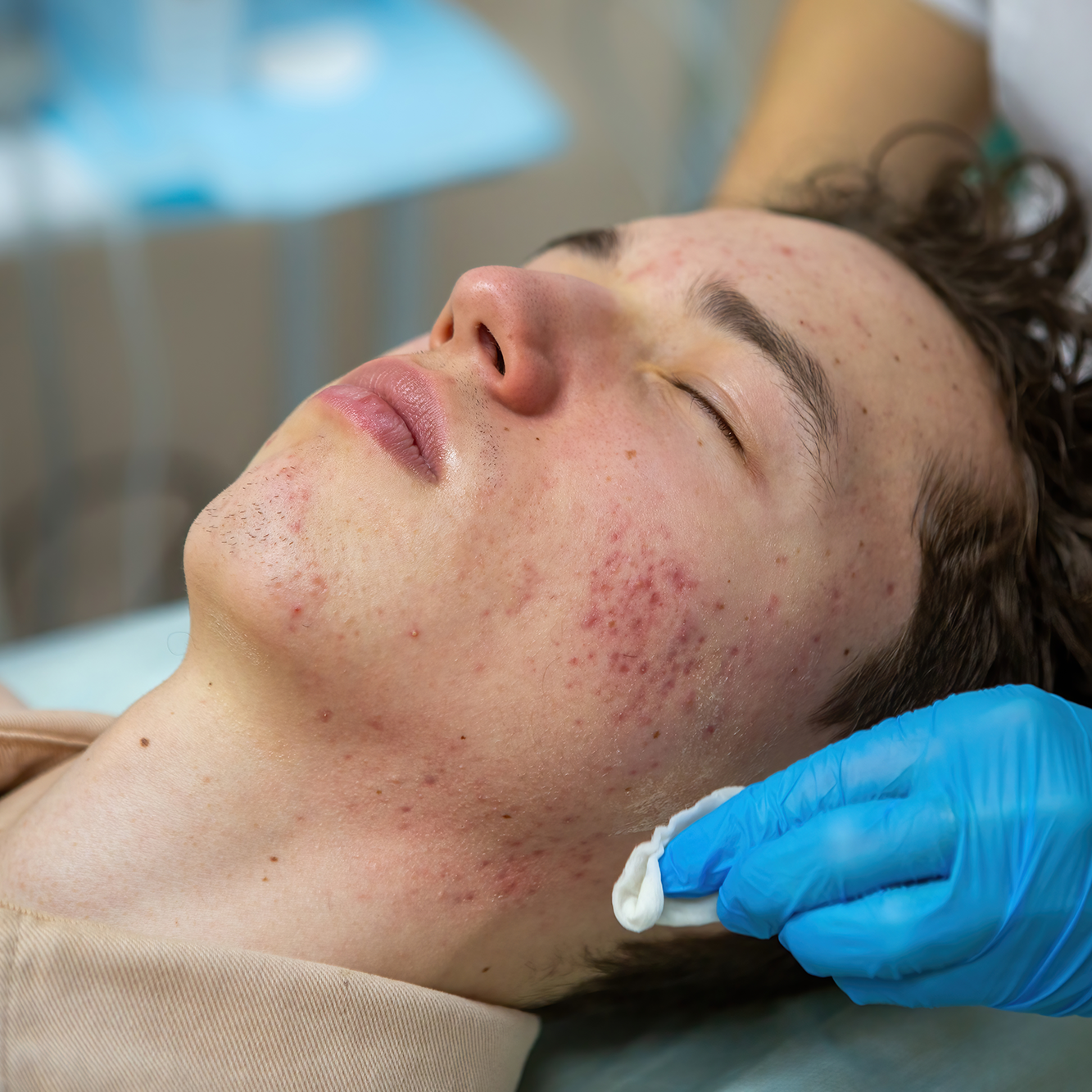 Tratamientos faciales Tratamiento antiacné Ana Hata Belleza